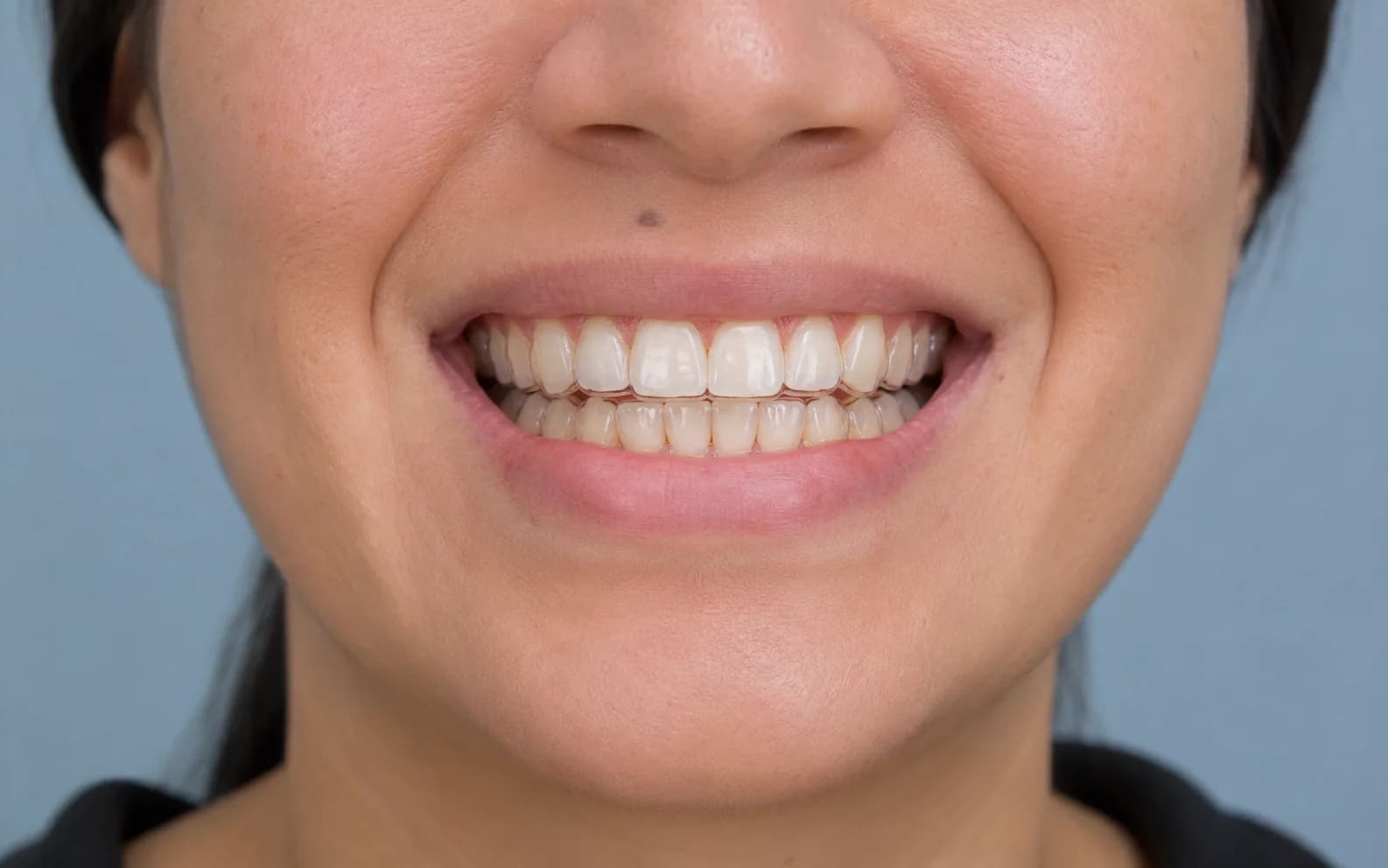 Fotografía clínica de una sonrisa con alineadores transparentes
